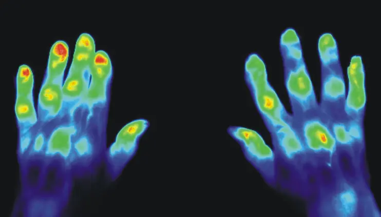 A medical picture of two hands with the aid of photoluminescent substances.
